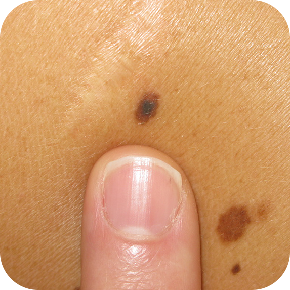 melanoma-images-dr-roger-graham-plastic-surgeon-cape-town